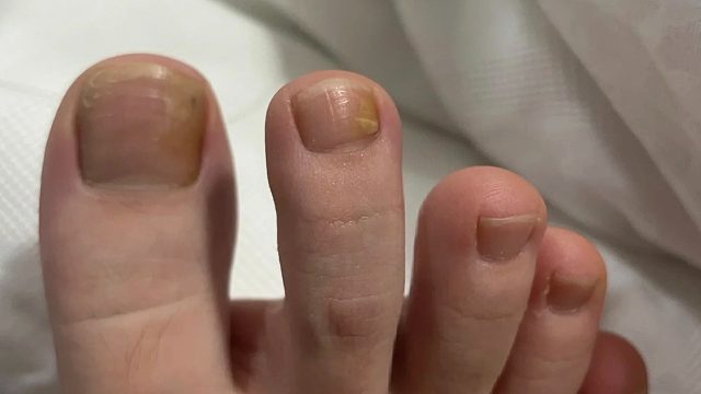 簡單3步去灰指甲！康復(fù)者成功經(jīng)驗分享！不多花一分冤枉錢！