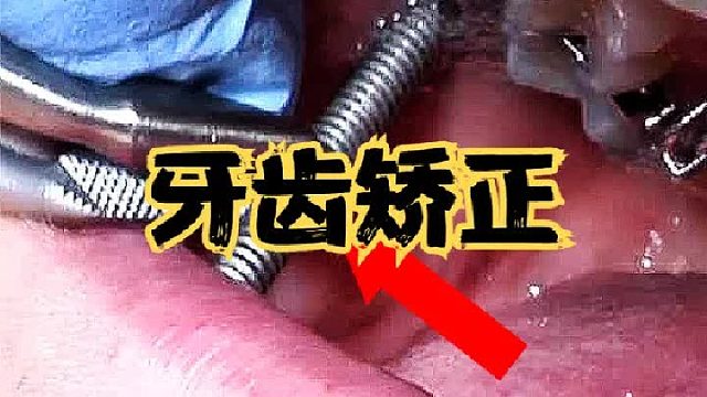 什么是“鋼牙機(jī)械嘴”？嘴里放兩根連接桿，戴上它如何吃飯刷牙？