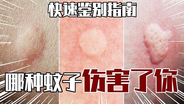 快速鉴别指南~哪种蚊子咬了我？？