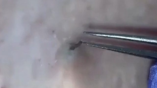 强迫症必看！！你知道一个毛孔里能藏多少毛发吗？