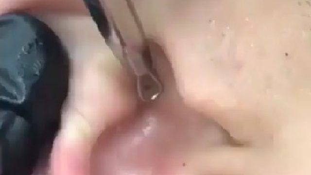 挤出外耳的黑头