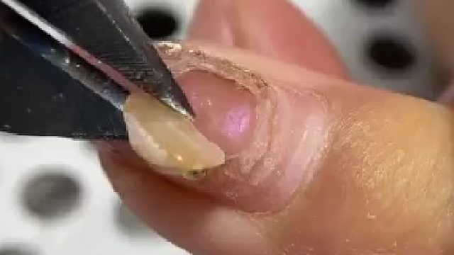 第一眼以为指甲烂了，要剪掉。