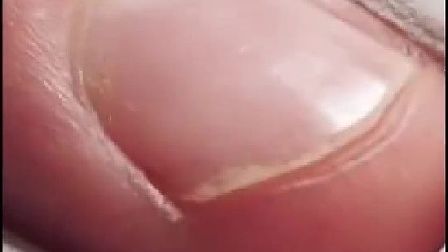 指甲生长过程。  全是菌