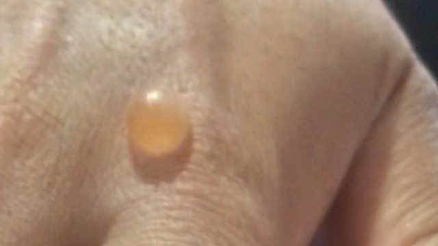 烫伤起泡后自行戳穿，慎点！！