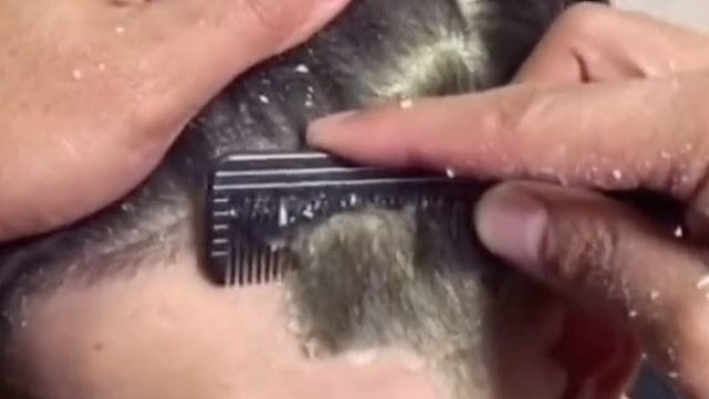 好好的皮屑，怎么涨那么多头发