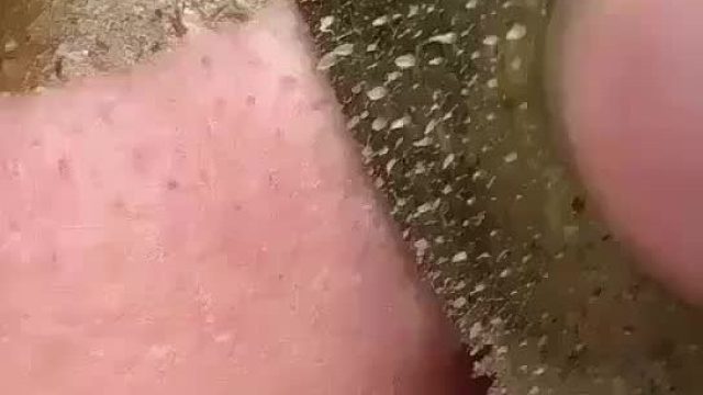 黑头一根根拔起，让你见证什么叫做一拉惊人