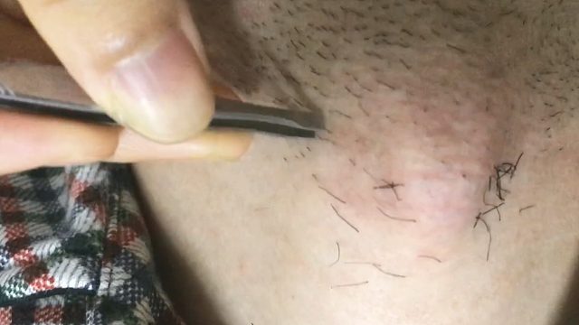 喉结拔毛一时爽，一直拔一直爽