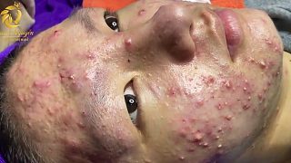 擠痘痘 擠黑頭