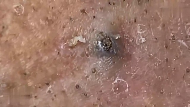 解压，老年痘痘