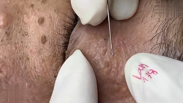 更新啦，继续解压，把痘痘黑头挤光光