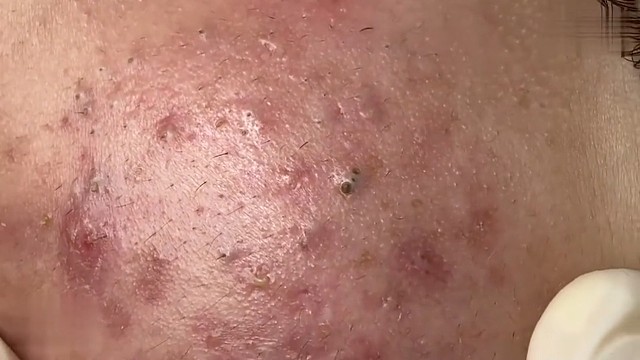 每日解压，清理黑头