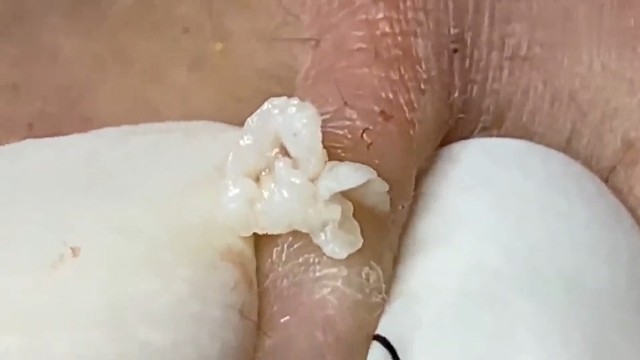 更新，耳根的大脓包