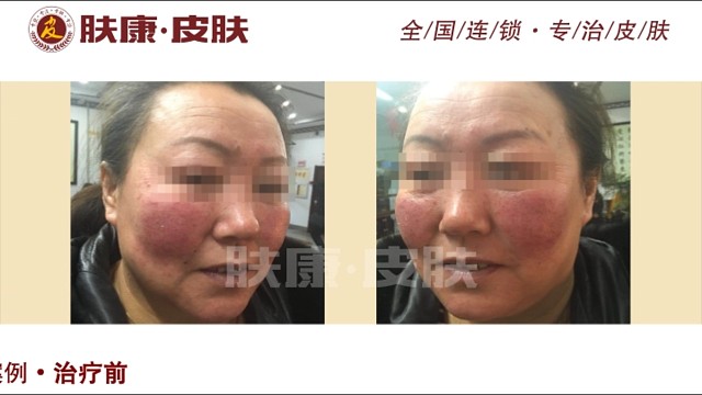 东莞肤康皮肤病医院治疗皮炎案例分享#皮炎##皮肤问题#