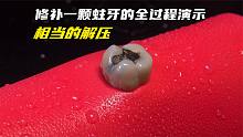 修补一颗蛀牙的全过程演示，不痛不痒非常简单，过程相当的解压