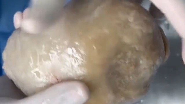 70岁大爷术后取出膀胱结石，竟有15厘米，表面光滑如玉