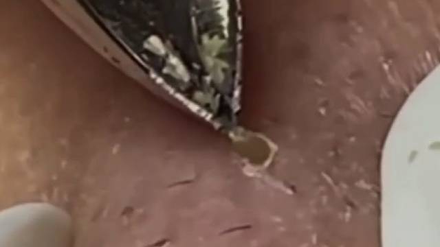 夹取黑头全过程，超级解压