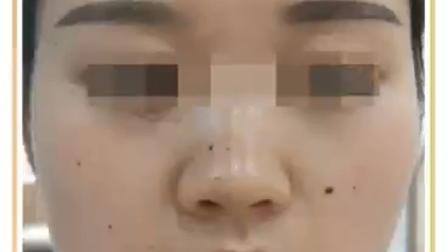 祛痣案例实录的分享，这样大家更清楚祛痣治疗情况，也能早日祛除身上的痣。
