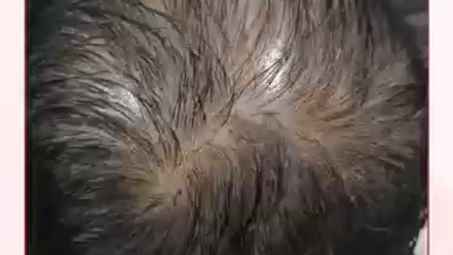 脱发案例实录，让脱发患者更清晰了解脱发问题的情况，也能早日看好身上的脱发问题。