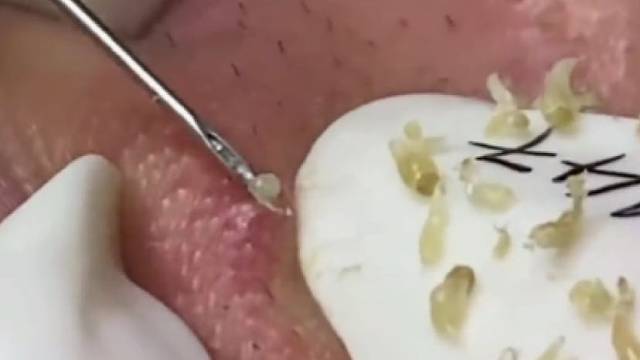 小伙脸上长满了黑头粉刺，清理过程解压又酸爽！评论区