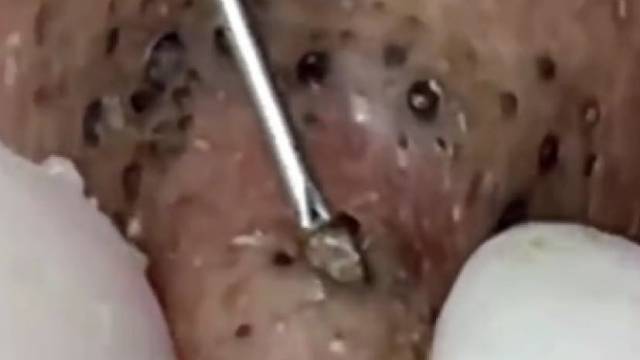 超解压挤痘痘视频，噎着口水看完