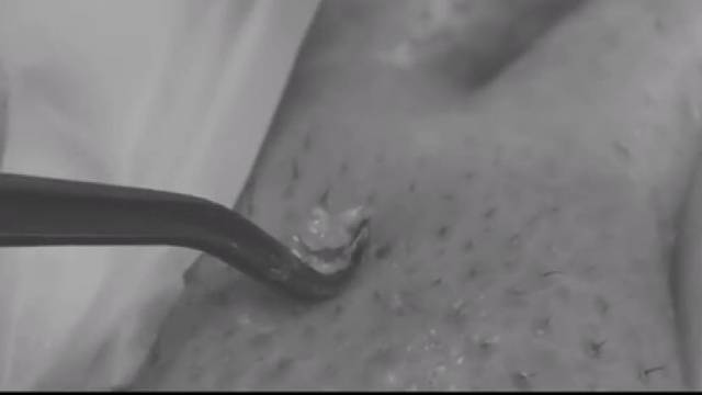 看去黑头挑战，极度解压