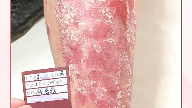 东莞肤康皮肤病医院治疗银屑病案例分享#银屑病##牛皮癣#
