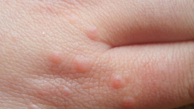 有皮肤问题的可以问我哦