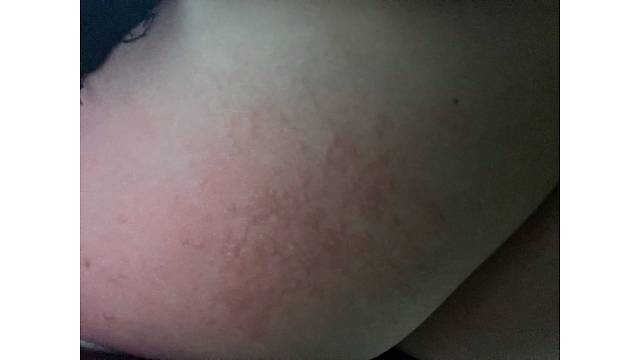 网吧第四天腿上这是咋了受潮了吗还是过敏了我可能要挑战失败了