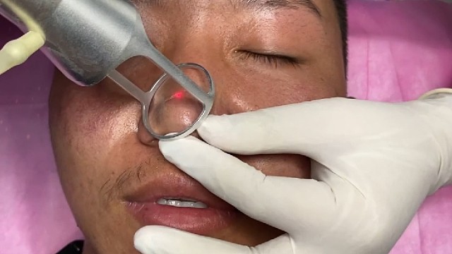 疤痕修复案例分享