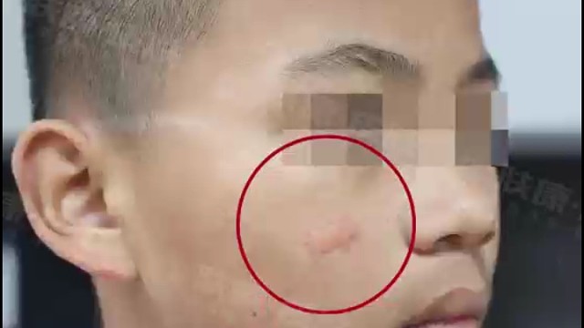 小朋友：我的疤痕终于去掉啦