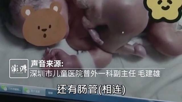 罕见！深圳一男婴出生四手四脚，50万分之一的概率！