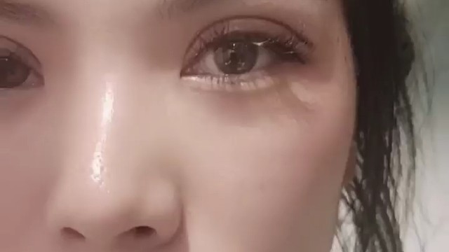 记录双眼皮第一天的恢复全过程