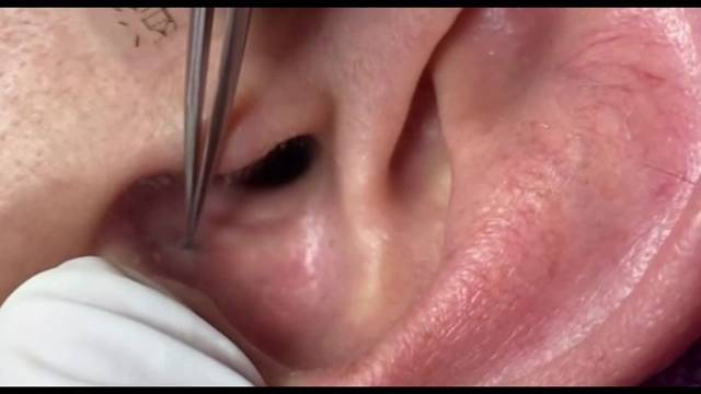 这么长的黑头，耳朵得穿孔了吧