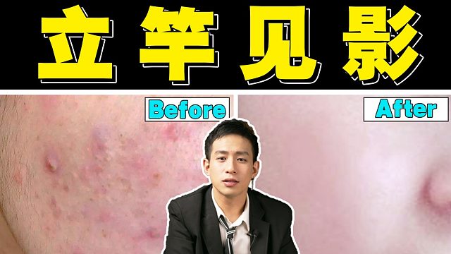 【医学博士】5min祛痘，立竿见影 I 人人适用的祛痘、护肤大法