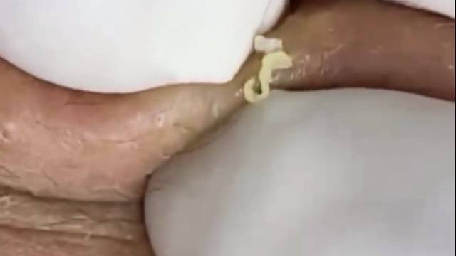 挤黑头-内有乾坤