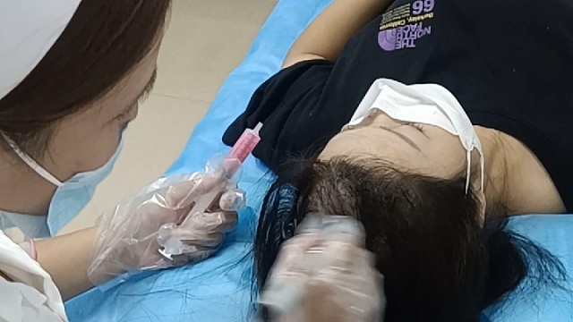 脱发治疗案例分享