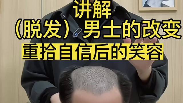 脱发男士的解决办法