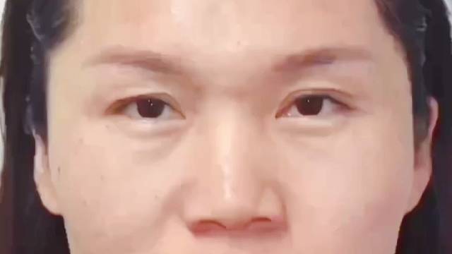 眉毛下垂通常可以选择找美颜医生做眉毛复位，伴有上睑皮肤松弛的，将下垂的皮肤进行减少