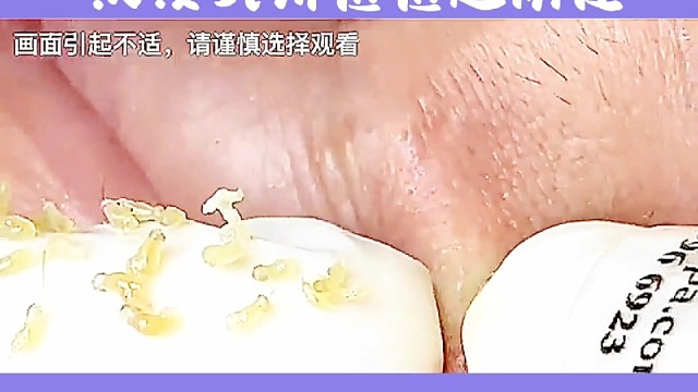 沉浸式痘痘超解压