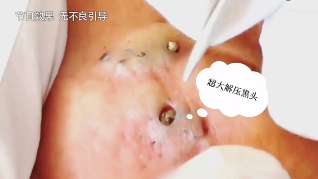 沉浸式解压挤痘痘