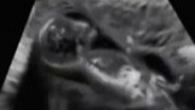 无痛人流，痛的只有那个孩子！