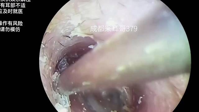 一起来看看多年没清理的耳朵吧