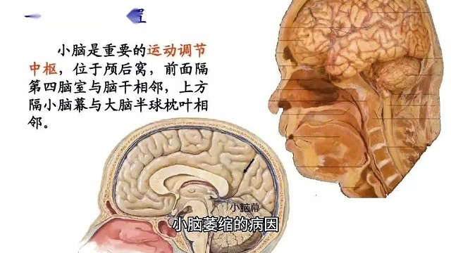 小脑萎缩