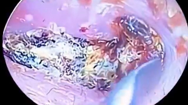 外国小哥哥攒了几十年的耳粑粑，终于掏得一干二净了！