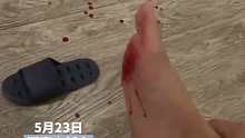 酒店拖鞋藏刀片女子脚被划伤