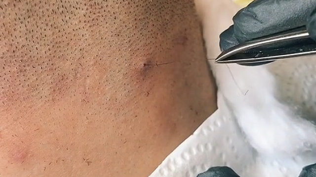 这是没长出来的头发？