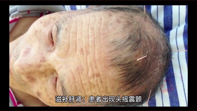 中医治疗特发性震颤的方法三