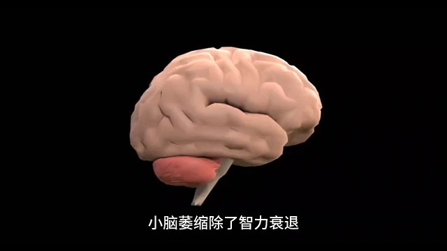 小脑萎缩