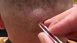 拔得過程真治愈。