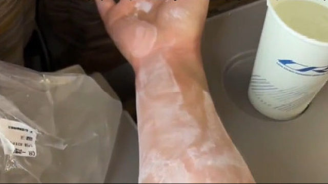 女子吃2口汉堡赶高铁过敏险休克 ：小麦运动型过敏